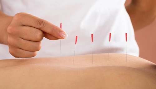 Dry Needling